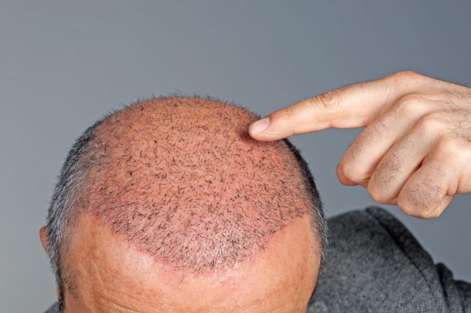 Understanding FUE Hair Transplant Cost: Factors and Considerations